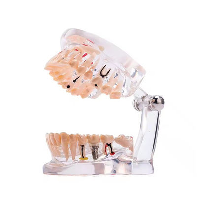 32 Răng Toàn tháng Bệnh cấy ghép Mô hình răng Thiết kế rõ ràng Mô hình bệnh lý răng